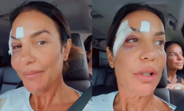 Ivete Sangalo recebe alta hospitalar e aparece com olho roxo após desmaio