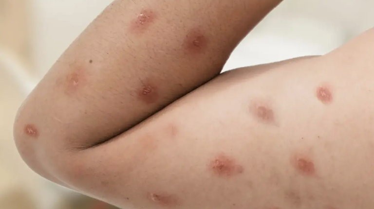 Bahia confirma os dois primeiros casos de Mpox em 2026